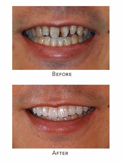 Swiftly Correct Misaligned Teeth | Cost-Effective Solutions