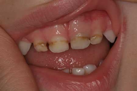 Early Childhood Caries - Homeopathic Dentistry