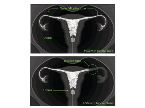 Hysterosalpingogram(HSG) Test Cost, Risks, Success Rate, Procedure ...