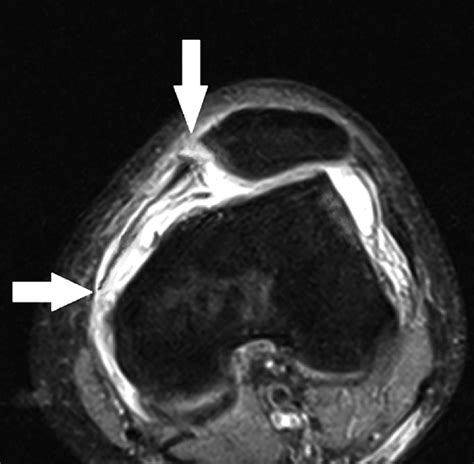 22-year-old woman was diagnosed with combined MPFL injury (complete... | Download Scientific Diagram