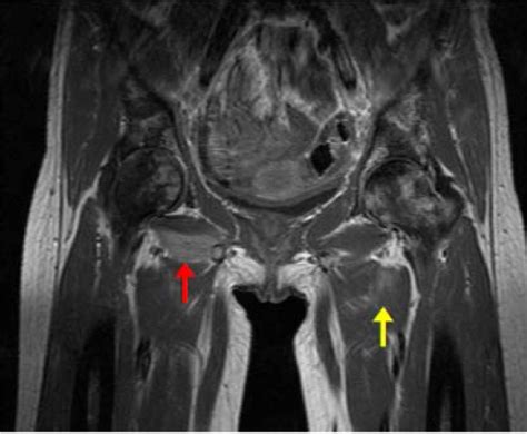 Obturator Muscle Mri