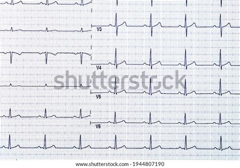 Ekg Heart Pulse On Graph Paper Stock Photo 1944807190 | Shutterstock