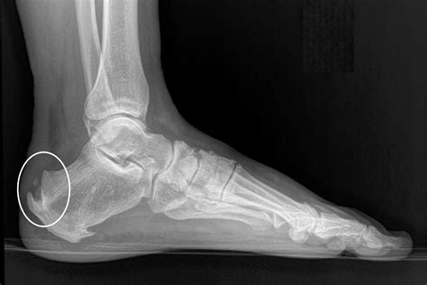 Achilles Tendonitis — Daniel Bohl, MD | Midwest Orthopaedics at RUSH