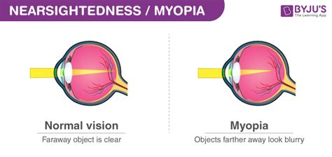 Myopia The Great Debate!, 53% OFF