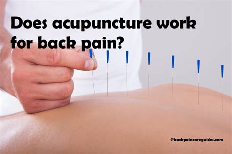 Does acupuncture work for back pain? Complete Guide