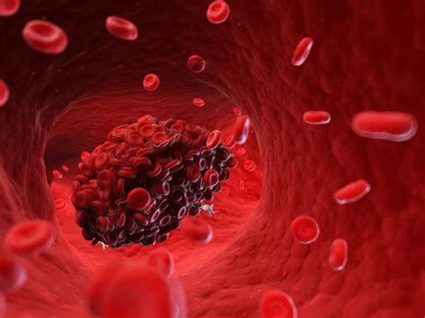 New imaging technique to identify and treat the blood clots