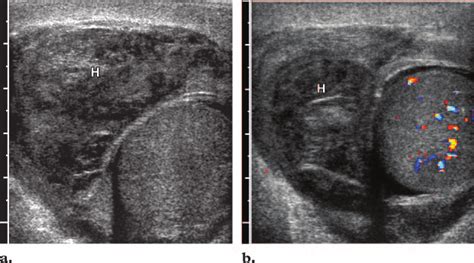 Extratesticular hematoma in a patient with scrotal swelling after a ...