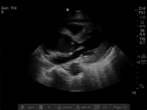 Dyspnea | BCPoCUS