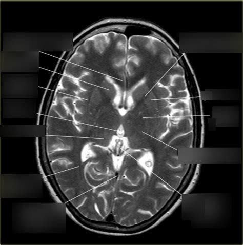 Brain CT Anatomy Diagram | Quizlet