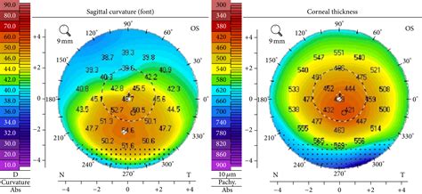 What To Know About Corneal Topography – Part 2 | Living with Keratoconus