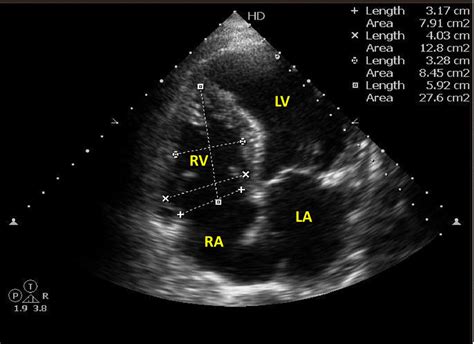 2D echo showing normal size of the right ventricle | Download ...