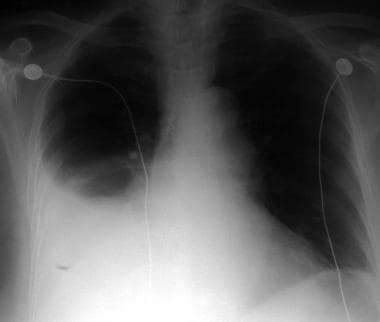 Hemothorax Workup: Approach Considerations, Laboratory Studies, Chest ...