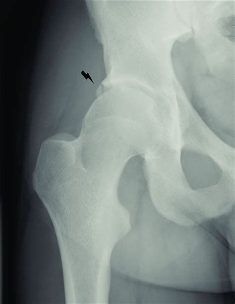 Stress fracture of the acetabular rim, with separation of a prominent ...