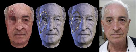ATOR: Low cost human face prosthesis with the aid of 3D printing