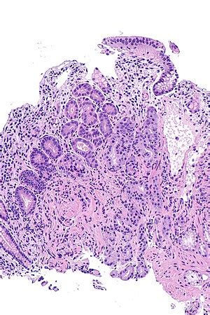 Autoimmune metaplastic atrophic gastritis - Libre Pathology