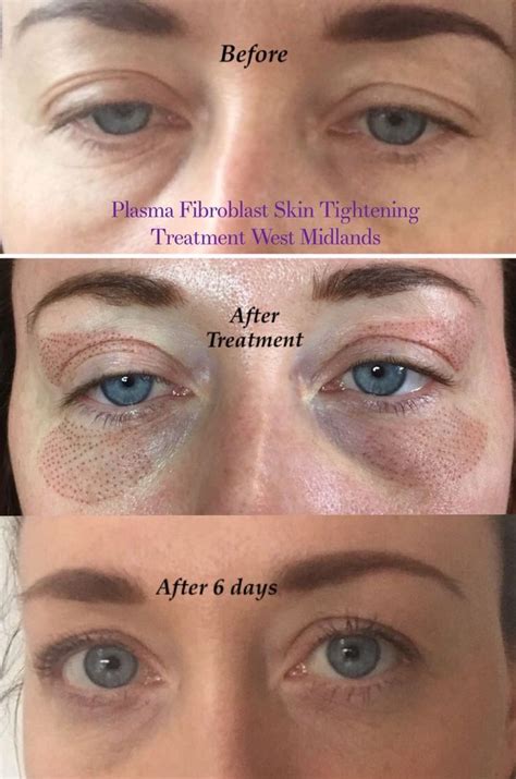 Plasma Fibroblast Skin Tightening Treatment on Upper & Lower Eyes 6 days after 1... - #Days ...