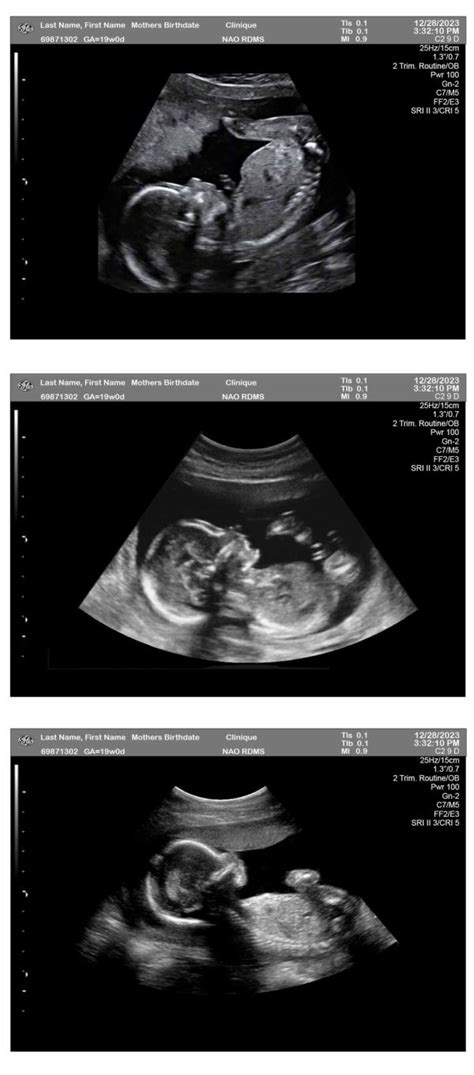 19 Week Pregnancy Ultrasound - Ultrasounds