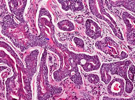 Pathology Outlines - Adenoid cystic carcinoma