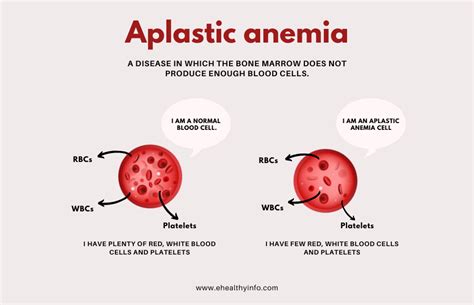 Aplastic Anemia - E-Healthy Info