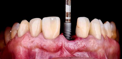 How much are dental implants - Dental News Network