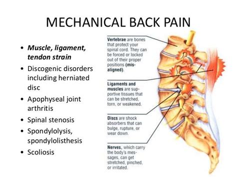 Low back pain