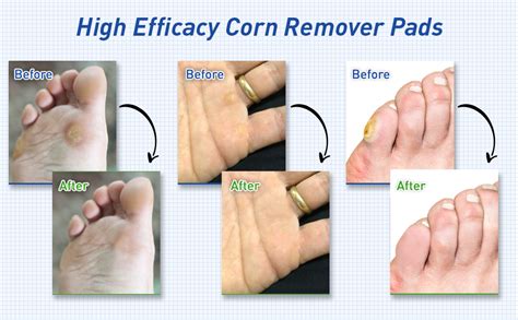 Corn Removal Before And After | ubicaciondepersonas.cdmx.gob.mx