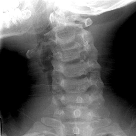 Traumatic atlantoaxial rotatory subluxation | Emergency Medicine Journal