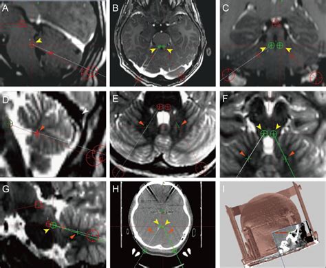 Determining the coordinates of the target superior cerebellar peduncles ...