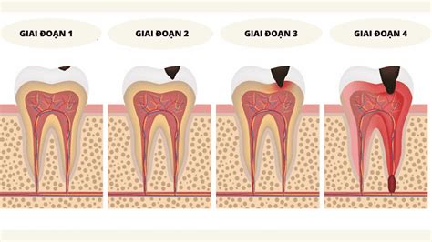 Quá Trình Sâu Răng Tiến Triển Bạn Không Thế Không Biết