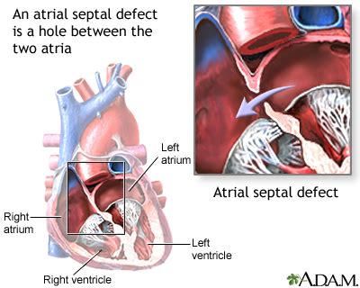 Atrial septal defect (ASD): MedlinePlus Medical Encyclopedia