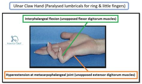 Claw Hand & Ulnar Paradox » How To Relief in 2021 | Ulnar nerve, Nerve ...