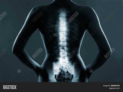 Human Backbone X-ray Image & Photo (Free Trial) | Bigstock