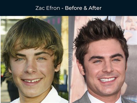 Celebrity Teeth Veneers