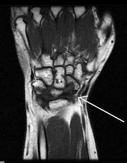 Avascular Necrosis Scaphoid-MRI - Sumer's Radiology Blog