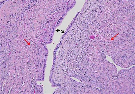 Globulomaxillary Cyst Histology