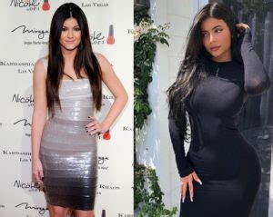 Kylie Jenner Before and After Plastic Surgery: Lips, Face, Body