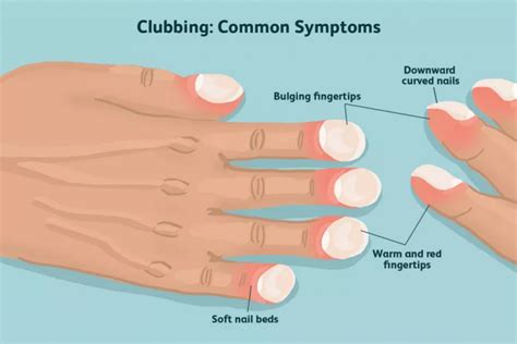 Pulmonary Fibrosis: Symptoms, Diagnosis, and Treatment