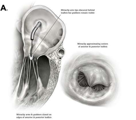 Transcatheter Edge to Edge Mitral Valve Repair (MitraClip) Step by Step ...