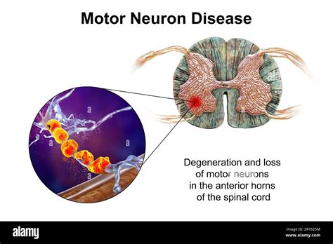 Motor neuron diseases, computer illustration showing degeneration of motor neurons in anterior ...