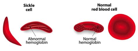 The Pharmacist's Guide to Sickle Cell Disease — tl;dr pharmacy