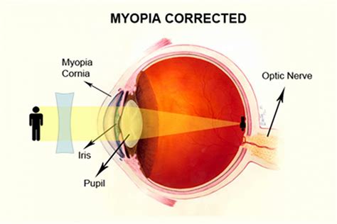 Myopia Control - A Cure For Nearsightedness? - EYE