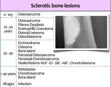 The Radiology Assistant : Sclerotic bone tumors