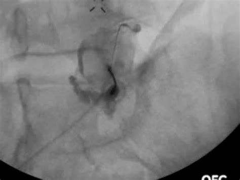 Right L5-S1 facet injection under fluoroscopic guidance - ThePainSource ...