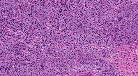 Squamous cell carcinoma of the cervix | Ottawa Atlas of Pathology