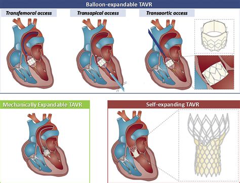 Transcatheter Aortic Valve Replacement - Cardiology Clinics