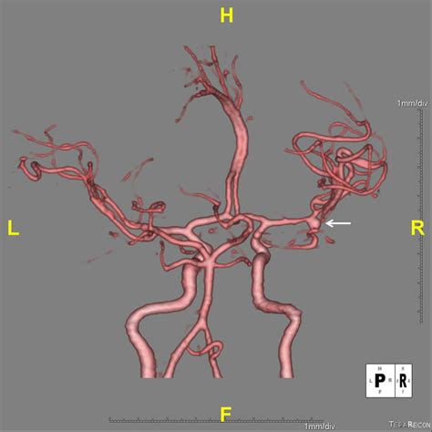 CT angiogram on readmission shows a 4 × 4 mm right MCA bifurcation... | Download Scientific Diagram