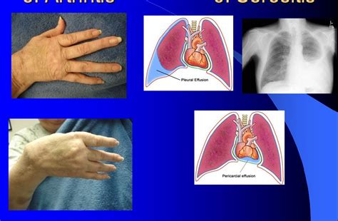 Serositis: Causes, Symptoms, Diagnosis, Treatment and Complications - Scope Heal