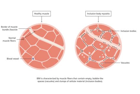 Inclusion Body Myositis treatment with stem cells | Swiss Medica