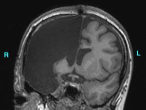 Hemispherectomy | Adolphs Lab