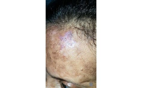 Early Scleroderma Skin Rash